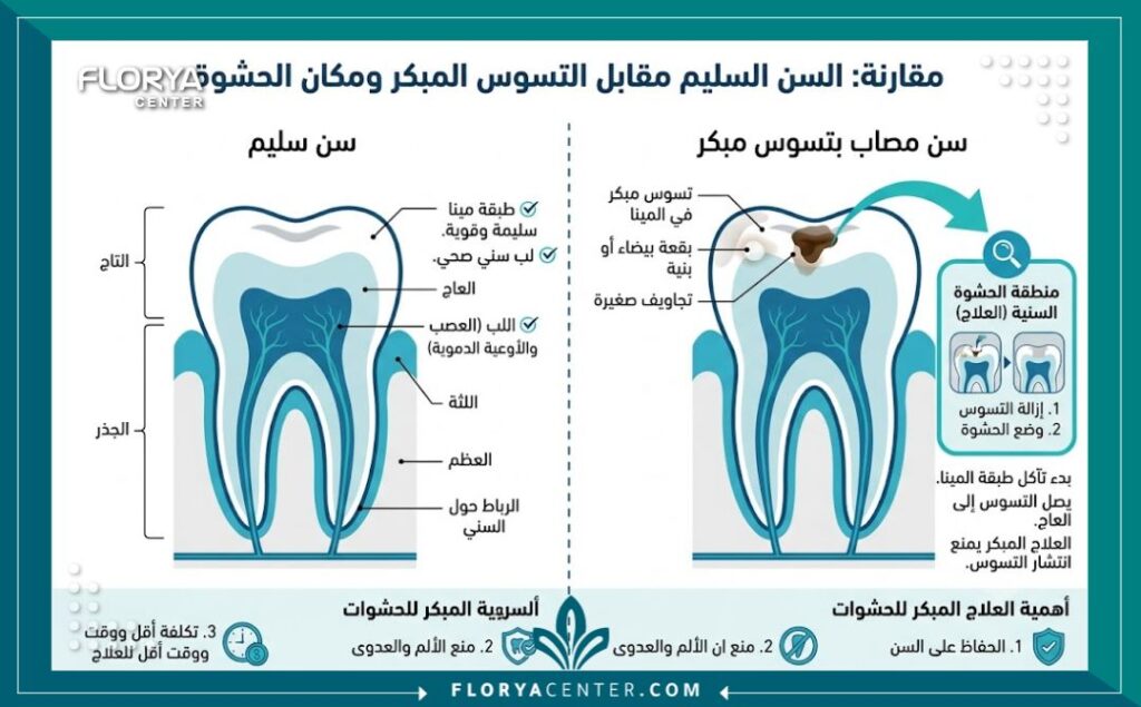 علاج تسوس الاسنان في تركيا 3 إنفوجرافيك طبي يوضح أهمية التدخل المبكر لتنظيف تسوس الأسنان وعلاج تسوس الاسنان في تركيا بالحشوات التجميلية.
