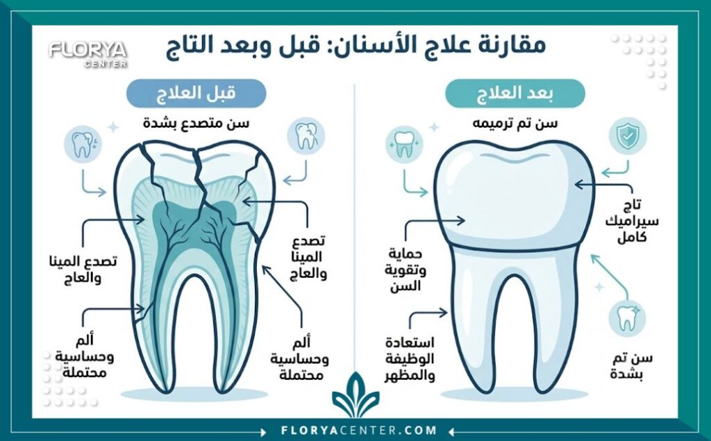 إنفوجرافيك يقارن بين حالة السن قبل وبعد علاج تكسر الأسنان باستخدام الحشوات التجميلية والتيجان.