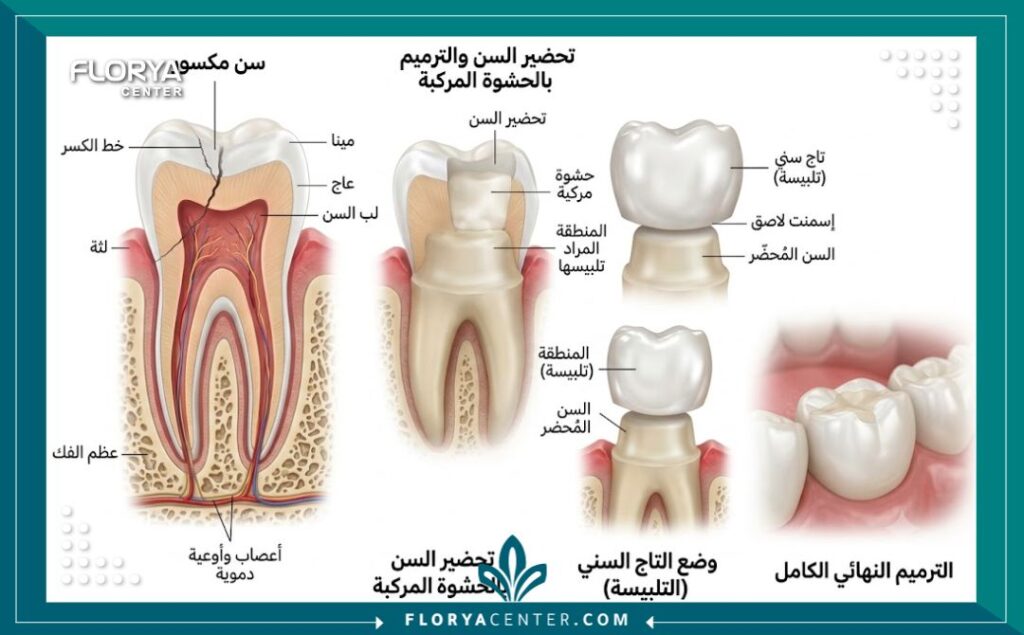 رسم توضيحي طبي ثلاثي الأبعاد يشرح تشريح السن المكسور وطبقات ترميم الأسنان المتهالكة بالتاج.