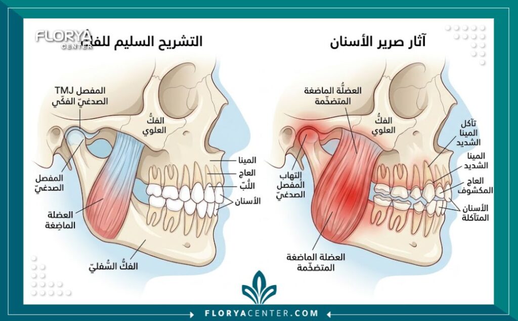 رسم طبي توضيحي يظهر تشريح الفك وعضلة المضغ وتأثير صرير الأسنان على تآكل المينا.