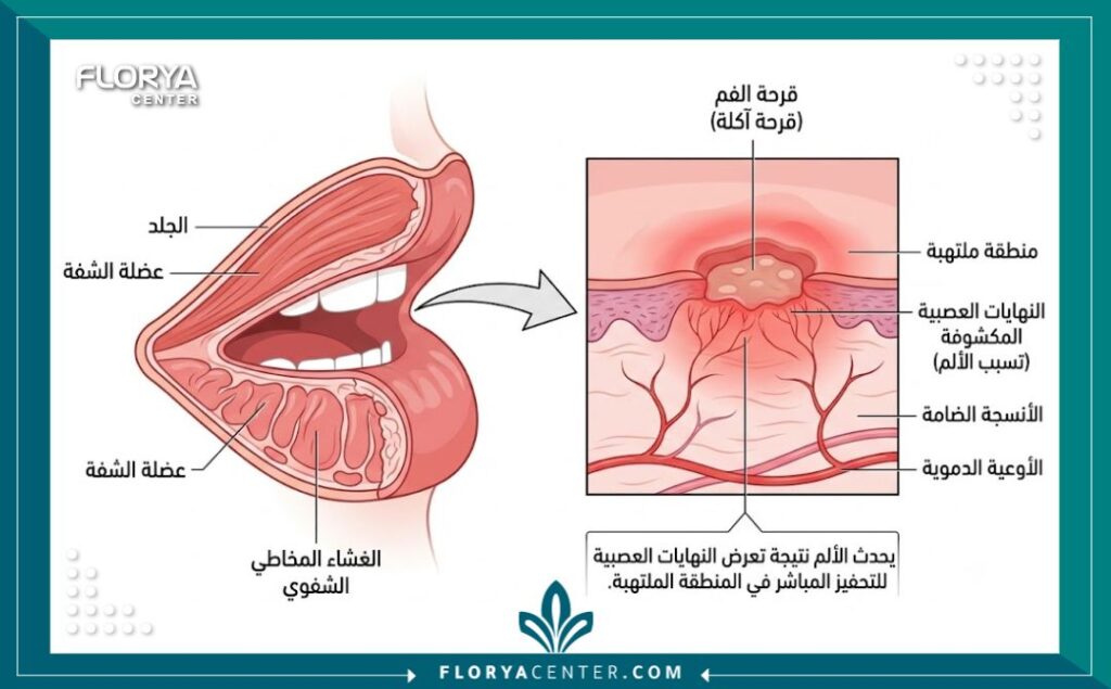 رسم توضيحي طبي يوضح تشريح قرحة الفم من الداخل وأسباب الشعور بالألم المتكرر.
