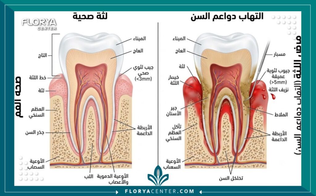 علاج نزيف اللثة في تركيا 2 رسم توضيحي طبي يقارن بين اللثة السليمة واللثة الملتهبة ويوضح تراكم الجير وتكون جيوب اللثة المسببة للنزيف.