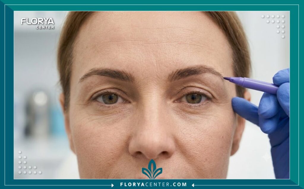 عمليات تجميل الحواجب والجفون في تركيا 5 لقطة مقربة تظهر دقة التخطيط الجراحي لرفع الحاجب وتجميل الجفن على وجه المريضة قبل العملية في عيادة بتركيا.