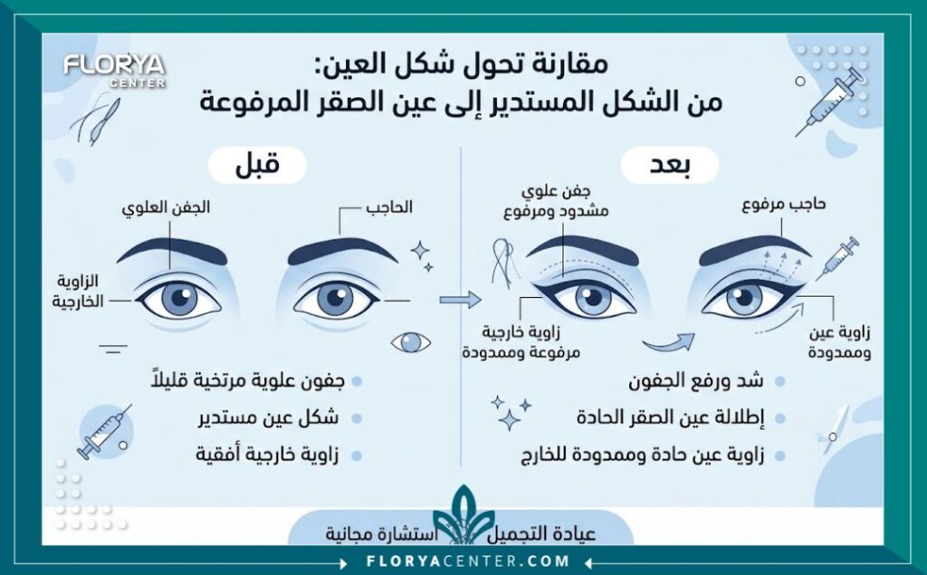إنفوجرافيك يوضح الفرق بين شكل العين الطبيعي والنتيجة بعد عملية عيون الصقور للحصول على نظرة ثاقبة.