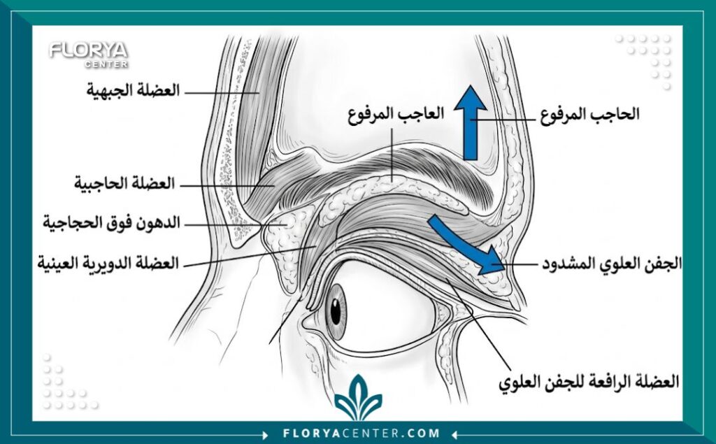 رسم توضيحي طبي لتشريح منطقة الحاجب والجفن، يوضح الهياكل العضلية والدهنية وكيفية تطبيق تأثير الرفع (أبروفل) لشد المنطقة وتوسيع العين.
