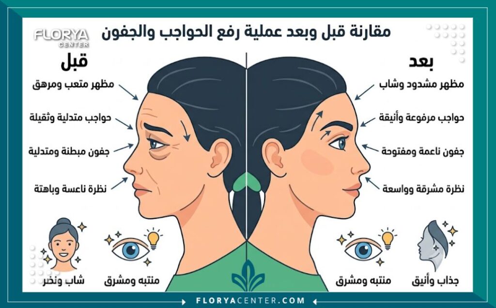 انفوجرافيك توضيحي عملية أبروفل للحواجب والجفون من حيث تطبيق تأثير الرفع (أبروفل)، يوضح شد الجفون ورفع الحواجب للحصول على نظرة شابة ومشرقة.