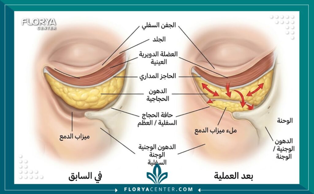 رسم طبي توضيحي يشرح تشريح العين وخطوات تقنية إعادة تموضع دهون الجفن السفلي لتعبئة التجاويف الغائرة.