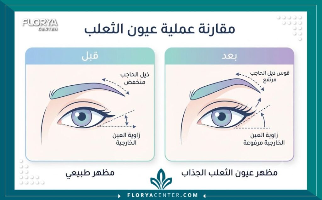 إنفوجرافيك مقارنة قبل وبعد يوضح زوايا العين ودرجة الرفع بعد الخضوع لعملية الفوكسي آيز في تركيا التريند الأشهر.