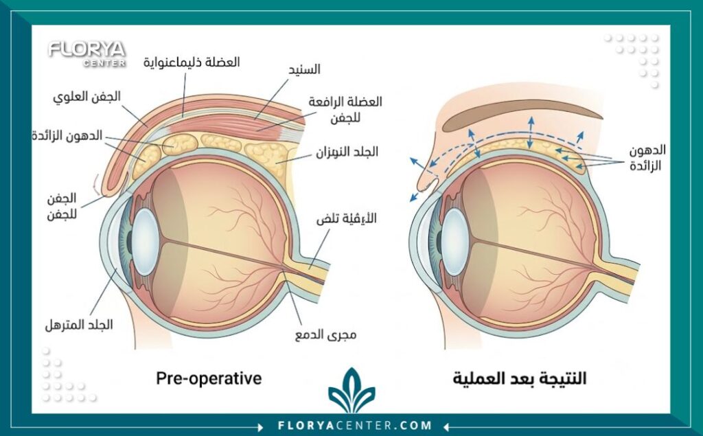 رسم توضيحي طبي ومفصل يوضح تشريح الجفن والمنطقة المحيطة بالعين، مع تسميات دقيقة باللغة العربية تشرح خطوات عملية شد الأجفان العلوية والسفلية وكيفية إزالة الدهون والجلد المترهل.