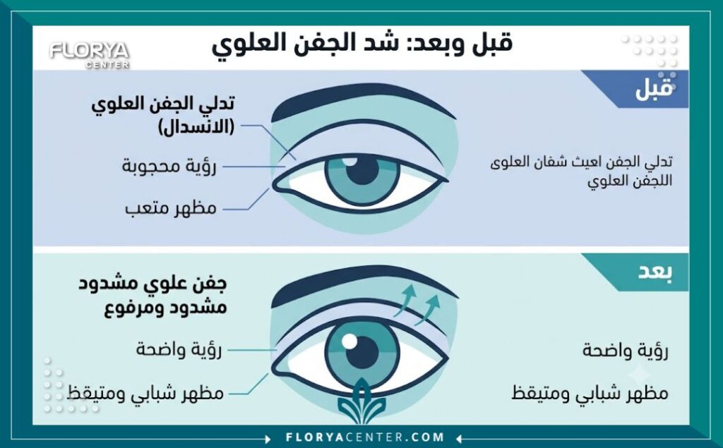 إنفوجرافيك يقارن بين شكل العين قبل وبعد إجراء عملية قص الأجفان العلوية المترهلة ويوضح الفارق في اتساع العين.