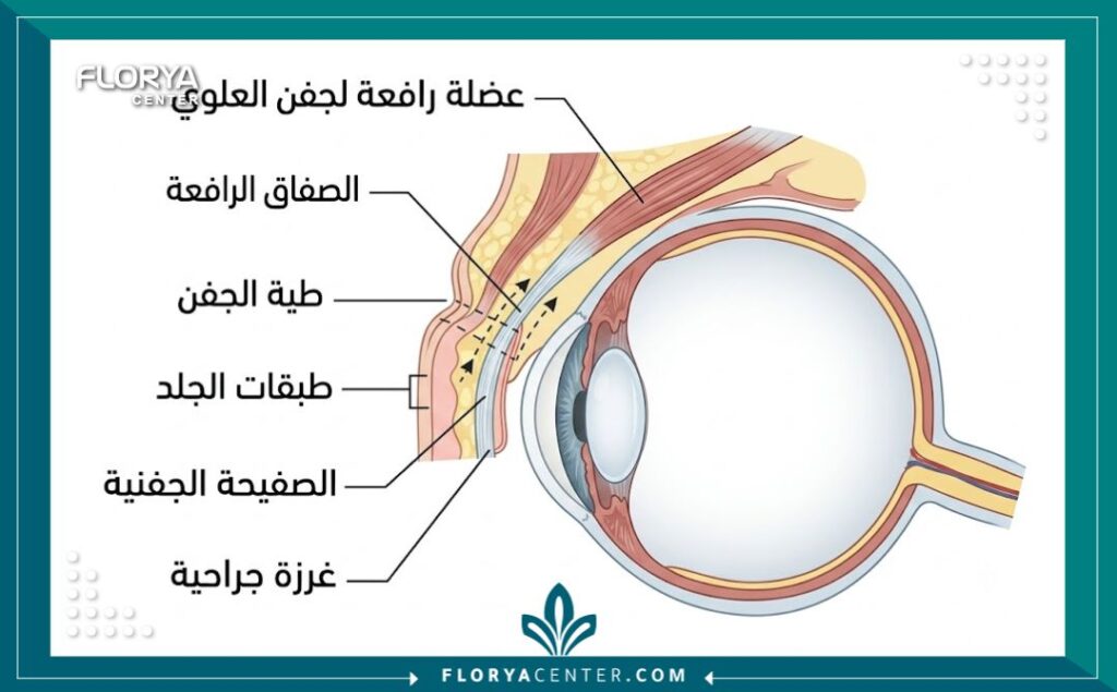 رسم توضيحي طبي لتشريح جفن العين العلوي يوضح كيف تتم عملية شد ثنية الجفن وتكوين الطية المزدوجة.