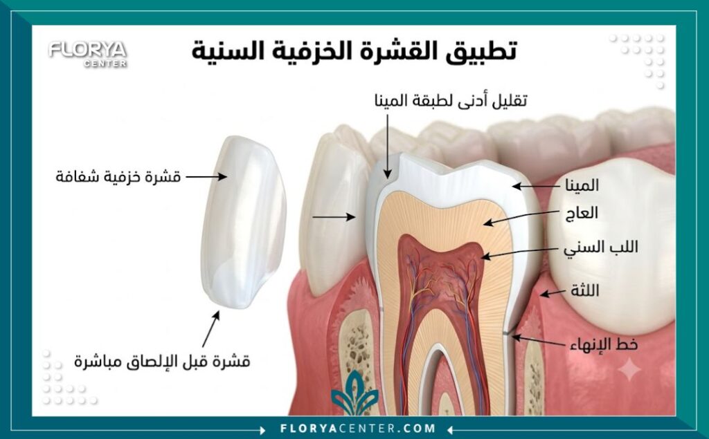 رسم طبي توضيحي يشرح كيفية تركيب فينير الاسنان ووضع القشرة الخزفية بعد برد السن بشكل بسيط.