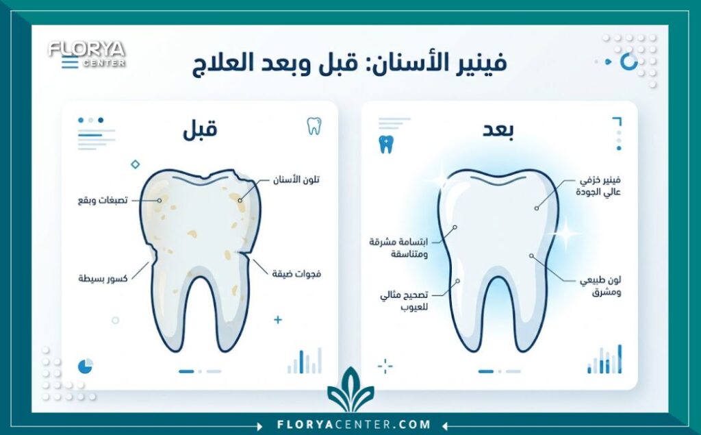 إنفوجرافيك يقارن بين شكل الأسنان قبل وبعد تركيب قشور الفينير الخزفية لعلاج التصبغات والعيوب.