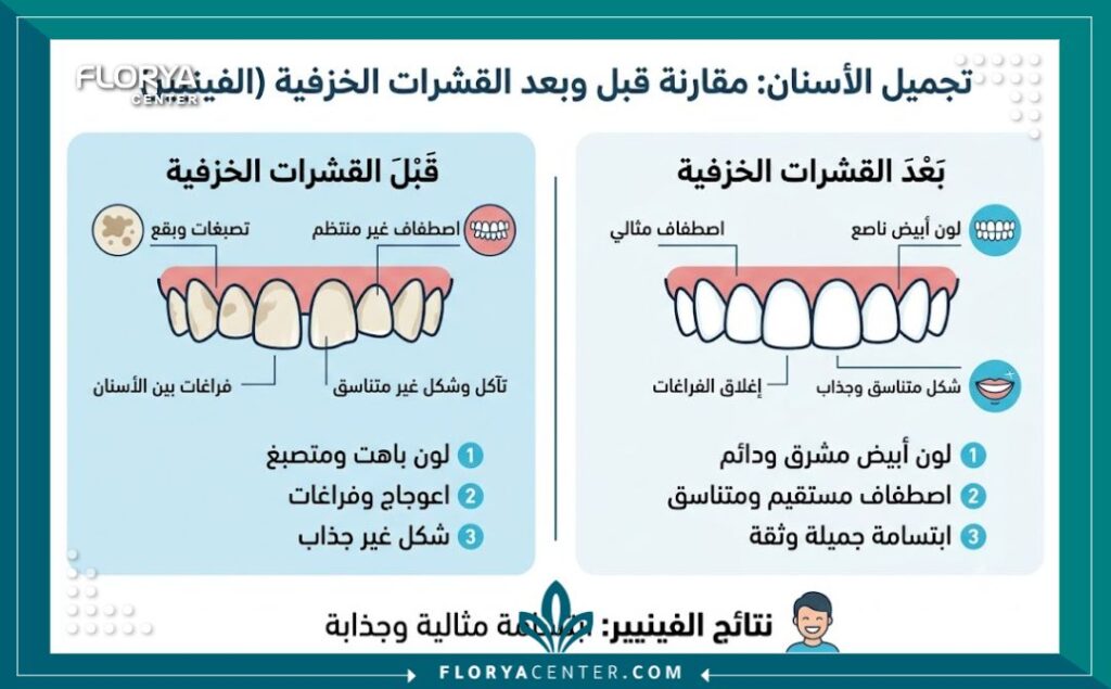 قشور الاسنان في تركيا 3 إنفوجرافيك يوضح مقارنة لفوائد وتأثير قشور الاسنان في تركيا على تغيير لون وشكل الأسنان.