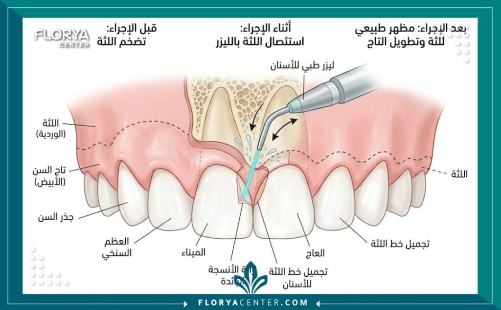 رسم توضيحي طبي يشرح خطوات عملية قص اللثة وإطالة التاج السني باستخدام الليزر.