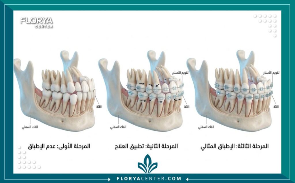 رسم توضيحي طبي يشرح مراحل حركة الأسنان وكم يستغرق تقويم الأسنان للوصول للنتيجة المثالية.