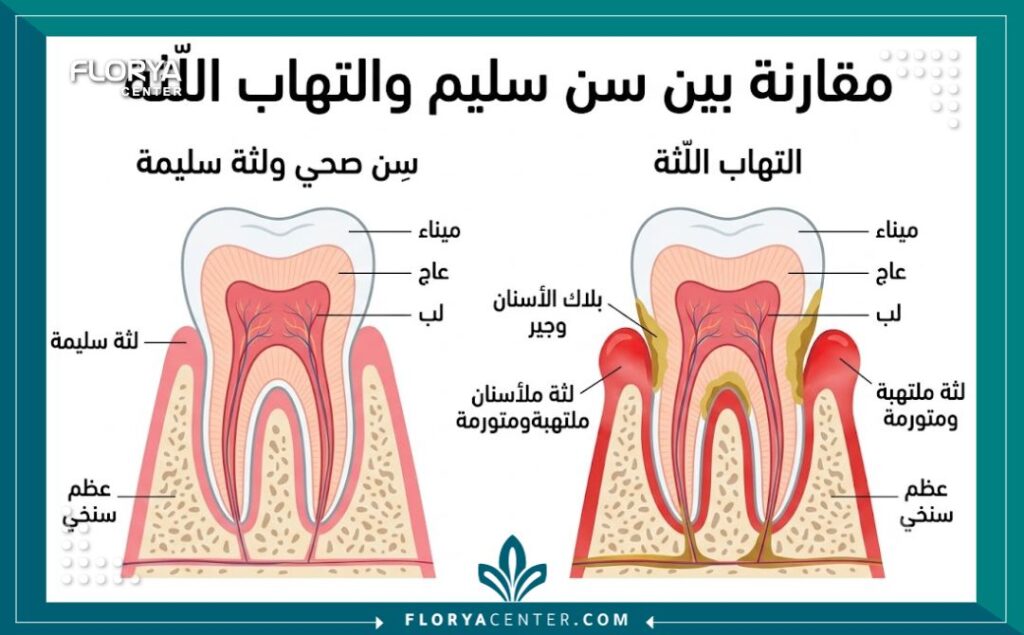 رسم توضيحي طبي يقارن بين اللثة السليمة واللثة الملتهبة لشرح أسباب التهابات الفم وتورم اللثة.