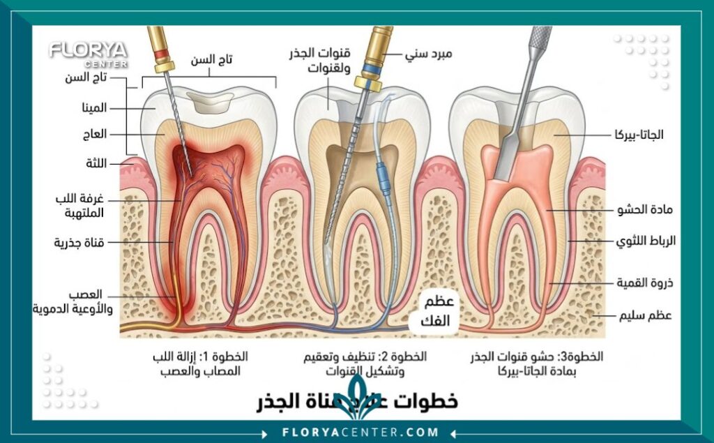 كيف يتم سحب العصب 2 رسم توضيحي طبي يشرح تشريح السن وخطوات كيف يتم سحب العصب وتنظيف القنوات الجذرية من الالتهاب.