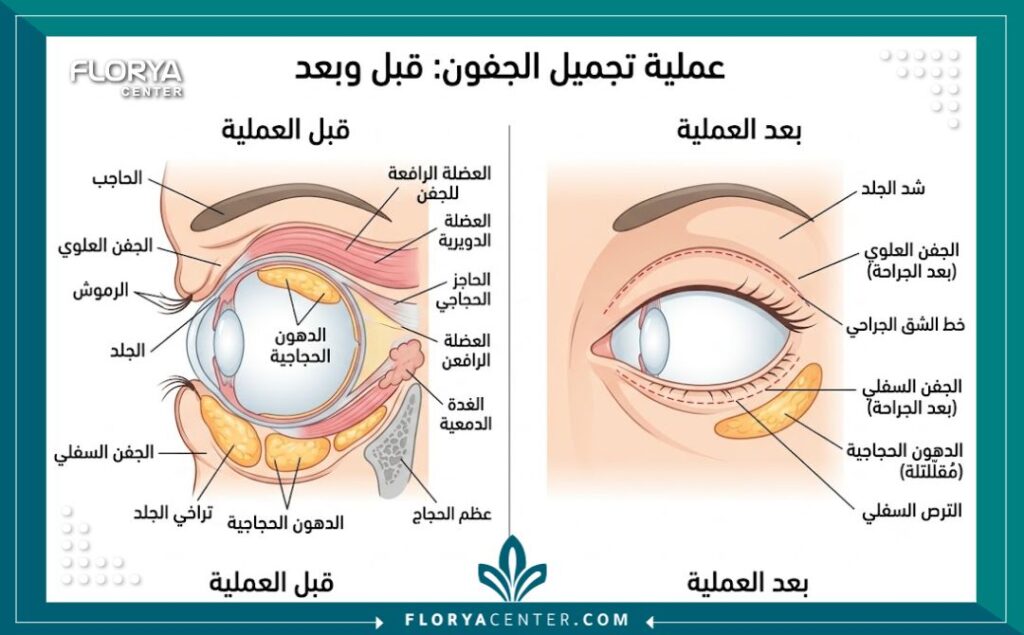 مخطط طبي يوضح تشريح الجفن العلوي والسفلي والتغيرات الهيكلية بعد عملية شد الجفون، مع تسميات دقيقة باللغة العربية تشرح الأنسجة والدهون والعضلات.