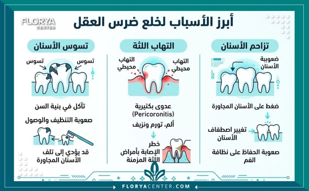 إنفوجرافيك طبي يوضح أهم دواعي خلع ضرس العقل مثل التسوس وتزاحم الأسنان والألم المستمر.