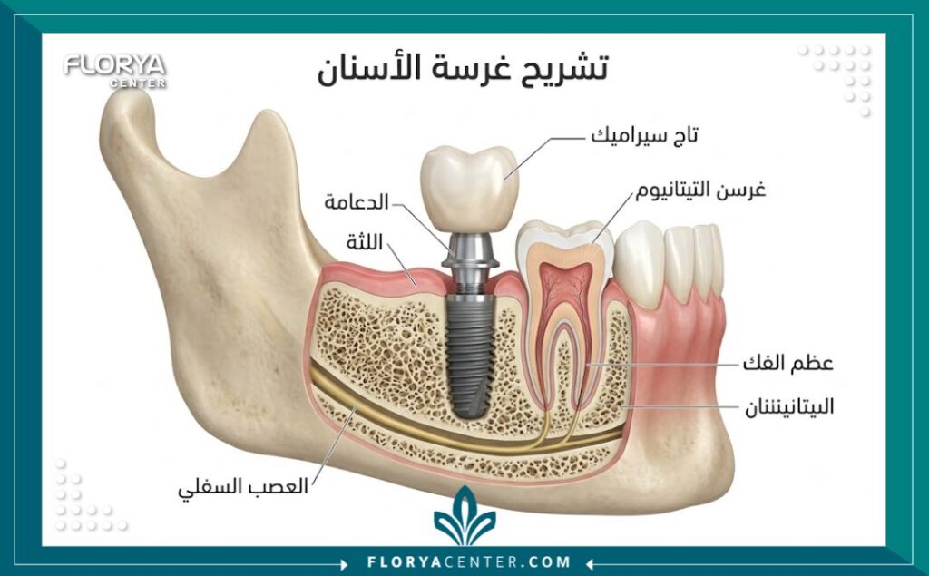 مراحل زراعة الاسنان في تركيا 2 رسم طبي توضيحي يشرح تشريح ومكونات الغرسة داخل الفك خلال خطوات زراعة الأسنان.