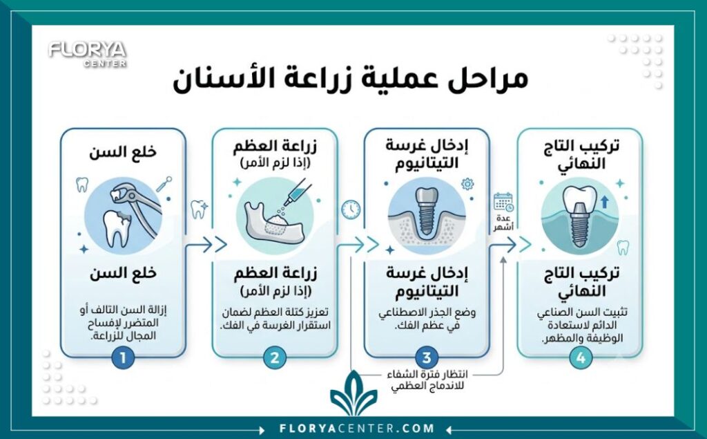 مراحل زراعة الاسنان في تركيا 3 إنفوجرافيك يوضح الجدول الزمني التفصيلي لخطوات ومراحل زراعة الاسنان في تركيا من الخلع وحتى التركيب.