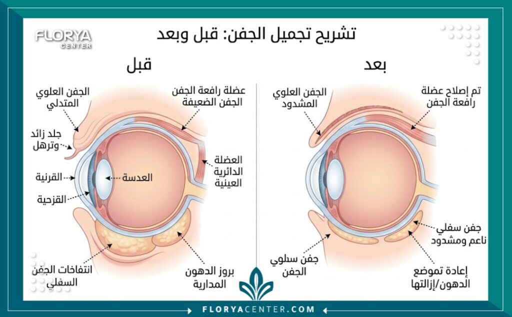 رسم توضيحي طبي لتشريح الجفن يوضح الفرق بين حالة الجفن قبل وبعد عملية الشد، مع تسميات باللغة العربية.