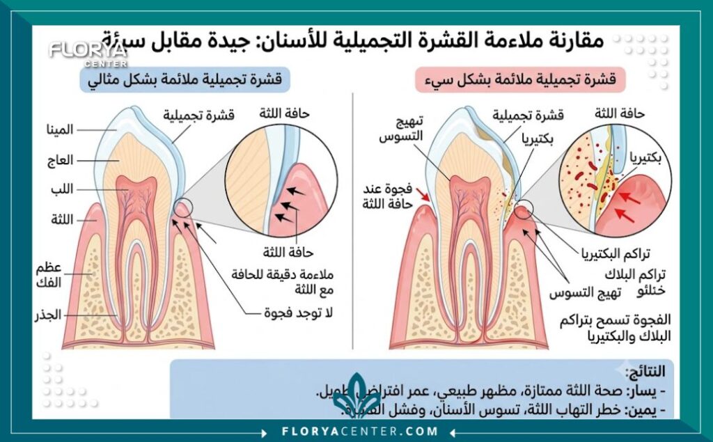 رسم توضيحي طبي يقارن بين التركيب الصحيح للفينير والتركيب الخاطئ الذي يسبب تراكم البكتيريا ورائحة الفم الكريهة.