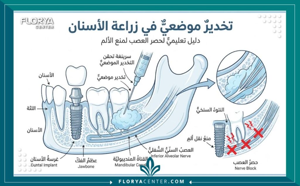 هل زراعة الاسنان مؤلمة 2 رسم توضيحي طبي لخطوات زراعة الأسنان يوضح كيف يمنع البنج الموضعي الشعور بألم ثقب العظم.