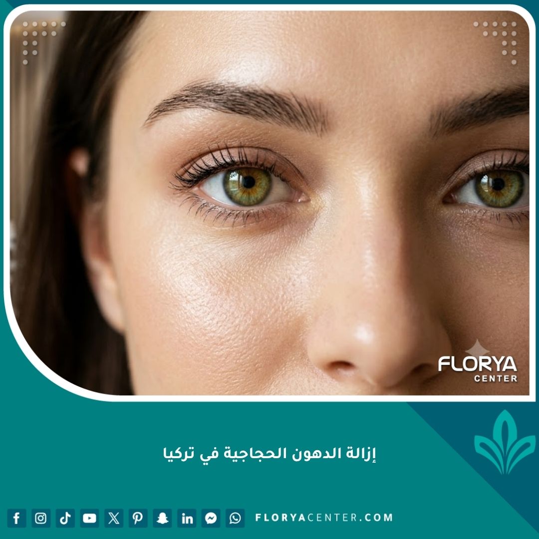 صورة مقربة تظهر جمال وشباب العينين بعد نجاح عملية إزالة الدهون الحجاجية في تركيا.