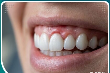 صورة مقربة لأسنان تظهر التهاب اللثة الذي يعتبر من أبرز اضرار ابتسامة هوليود 3D.