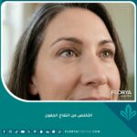نتيجة فعالة للتخلص من انتفاخ الجفون وعلاج أكياس العين بعد الإجراء التجميلي.