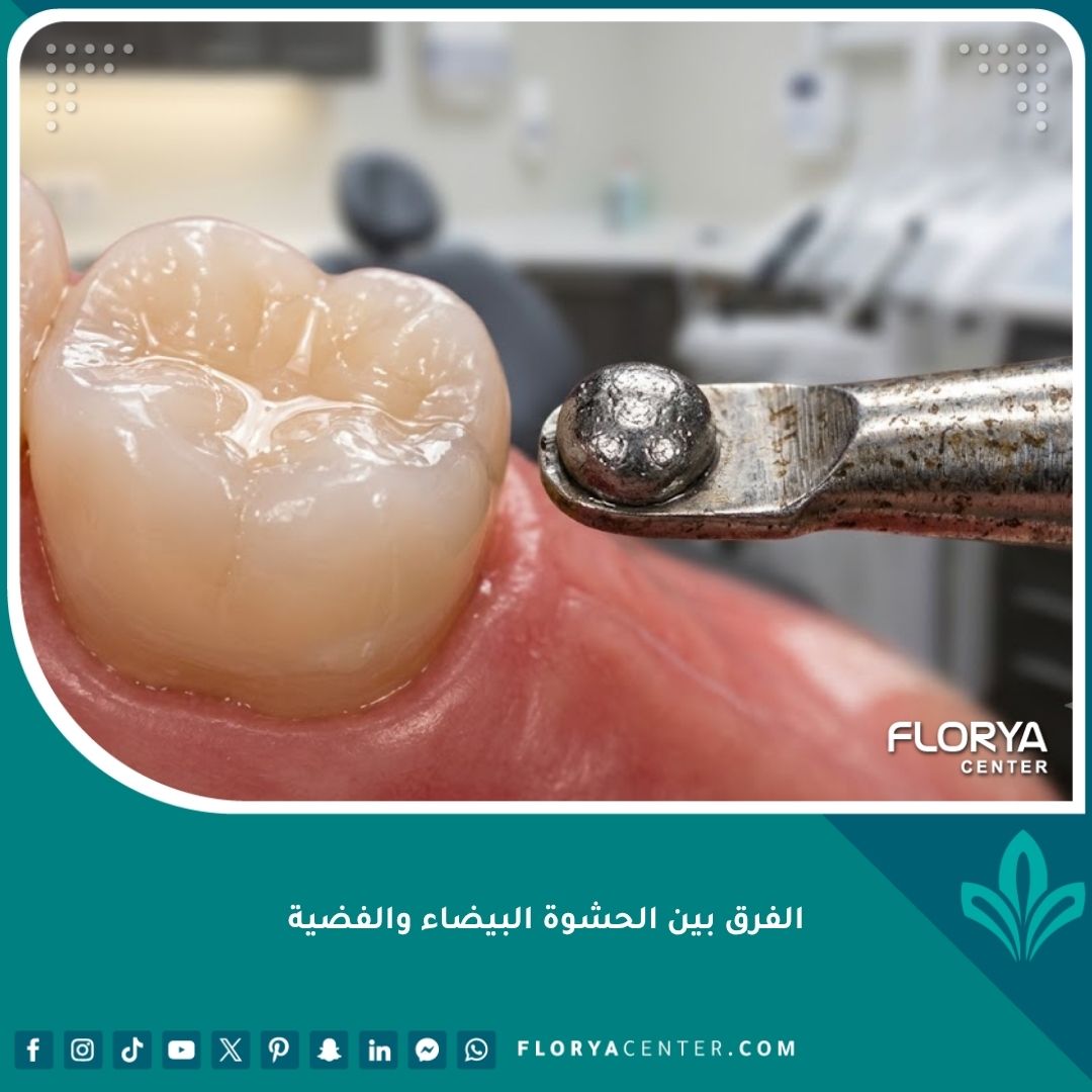 صورة مقربة عالية الدقة توضح الفرق بين الحشوة البيضاء التجميلية الكومبوزيت والحشوة الفضية المعدنية.