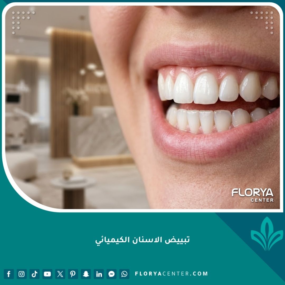 صورة مقربة لابتسامة ناصعة البياض وجميلة بعد الخضوع لجلسة تبييض الاسنان الكيميائي الاحترافي.