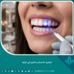 ابتسامة مثالية بعد تجميل الاسنان بالليزر في تركيا، تبييض الأسنان وقص اللثة بدون ألم.