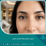 صورة مقربة لعينين جميلتين ووجه مشرق بعد نجاح عملية تجميل الجفون وإزالة الكيس الدهني.