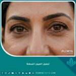 صورة تجميلية سينمائية لامرأة عربية في منتصف العمر بعد جراحة تجميل العيون المبطنة في اسطنبول، تُظهر عيوناً مفتوحة ومحددة بشكل طبيعي وتخفي الجلد السميك الزائد، مع نظرة واثقة ومشرقة. (تجميل العيون المبطنة)