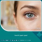صورة مقربة لعيون واسعة وجذابة تبرز نتائج عملية تجميل العيون الناعسة وعلاج ارتخاء الجفون.