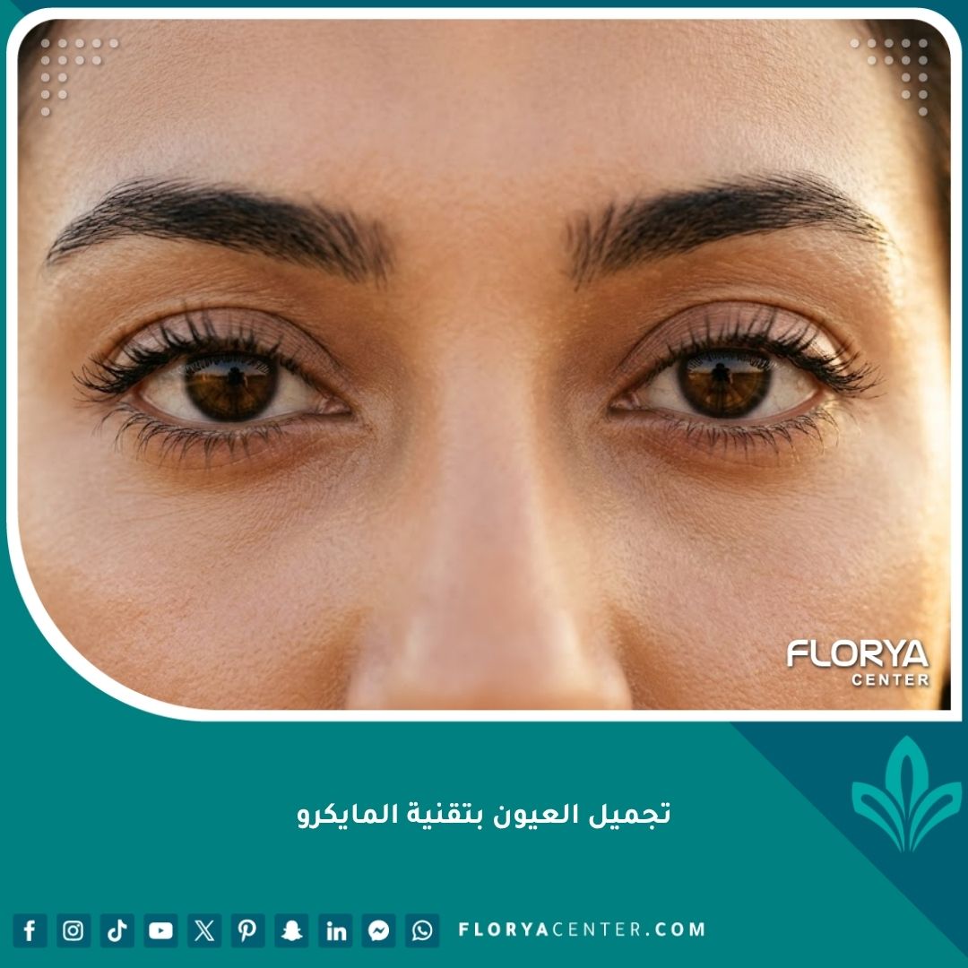 عيون مشرقة وشابة بعد عملية تجميل العيون بتقنية المايكرو في اسطنبول دون أي ندبات مرئية.