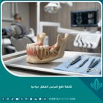 تكلفة خلع ضرس العقل جراحياً في عيادة أسنان متطورة