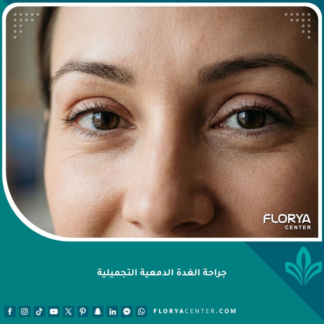 نتيجة جراحة الغدة الدمعية التجميلية لشد الجفن العلوي.