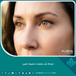 نتائج جراحة شد عضلات محيط العين تظهر عيون شابة ومشدودة وبشرة خالية من التجاعيد.