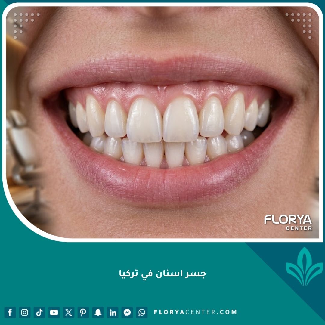 صورة مقربة لابتسامة مثالية تبرز جودة وجمالية تركيب جسر اسنان في تركيا بمظهر طبيعي.