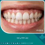 صورة مقربة لابتسامة صحية ولثة وردية سليمة تعبر عن نجاح علاج جيوب اللثة في تركيا.