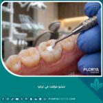 صورة مقربة تظهر طبيب أسنان يضع حشو مؤقت للأسنان بدقة داخل عيادة متطورة في تركيا.