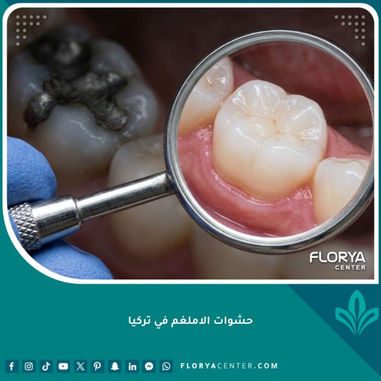 صورة مقربة تظهر استبدال حشوات الاملغم الفضية القديمة بحشوات تجميلية بيضاء حديثة وآمنة في تركيا.