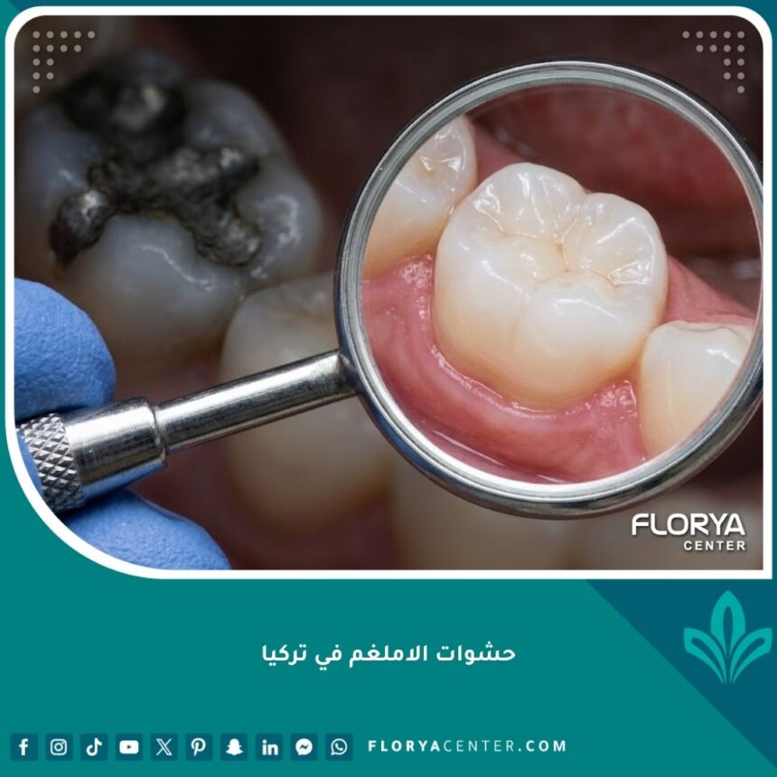 صورة مقربة تظهر استبدال حشوات الاملغم الفضية القديمة بحشوات تجميلية بيضاء حديثة وآمنة في تركيا.