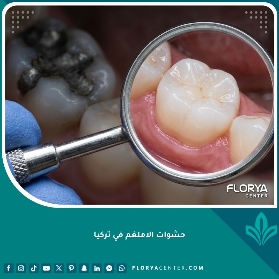 صورة مقربة تظهر استبدال حشوات الاملغم الفضية القديمة بحشوات تجميلية بيضاء حديثة وآمنة في تركيا.