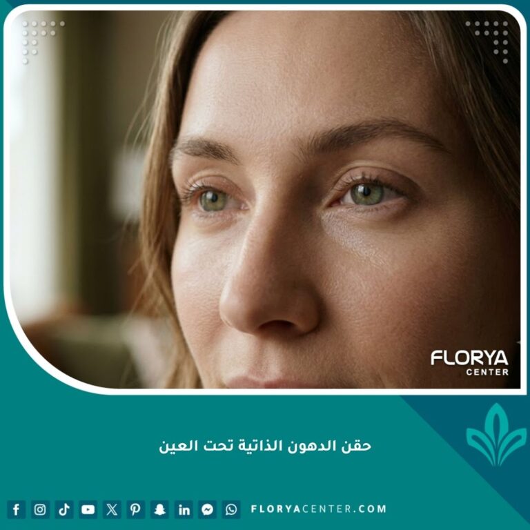 صورة مقربة سينمائية تظهر نتائج طبيعية وممتلئة تحت العين بعد حقن الدهون الذاتية بالخلايا الجذعية في تركيا.