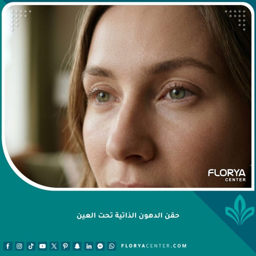 صورة مقربة سينمائية تظهر نتائج طبيعية وممتلئة تحت العين بعد حقن الدهون الذاتية بالخلايا الجذعية في تركيا.